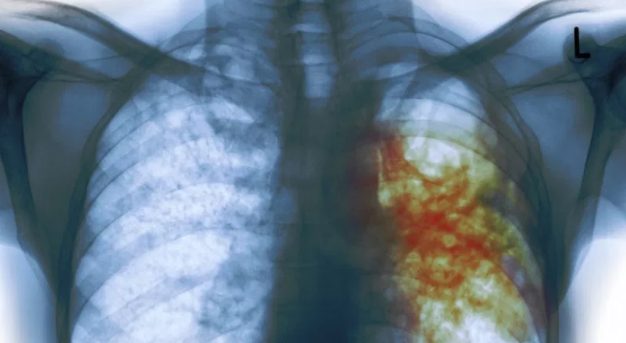Tuberculosis: se transmite por la saliva y el consumo de tabaco aumenta el riesgo de contraer la enfermedad