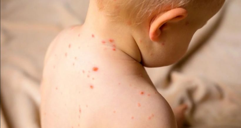 El 1ro de octubre comenzará la campaña nacional de vacunación contra el sarampión y la rubéola