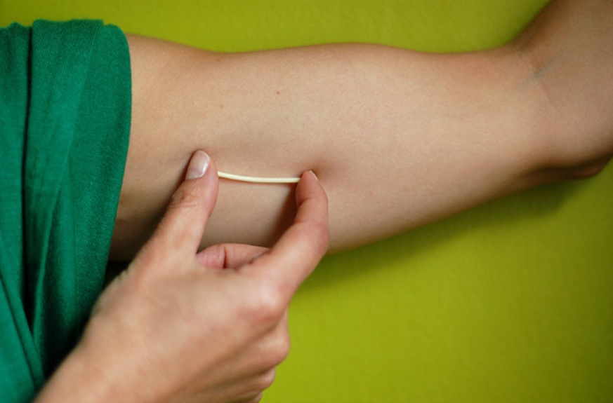 Continúan los operativos de colocación de métodos anticonceptivos de larga duración