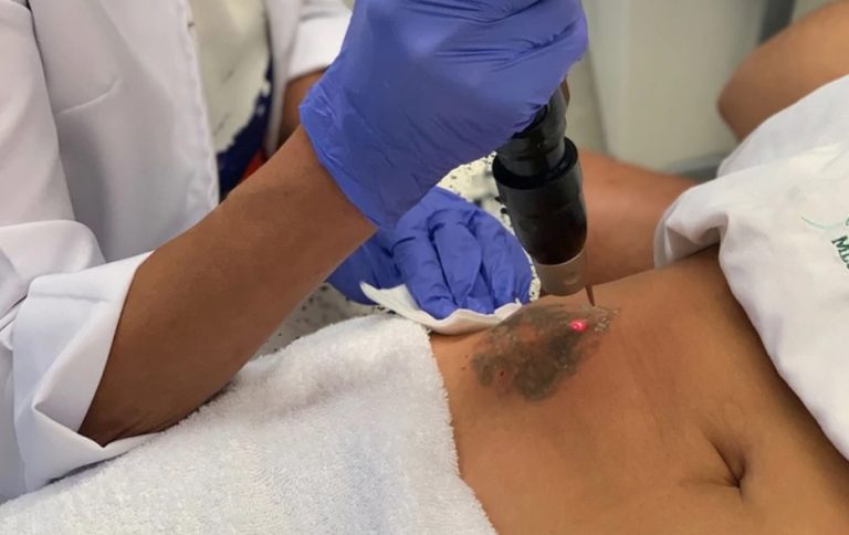 Nueva tecnología que permite borrar los tatuajes de manera efectiva y sin dolor