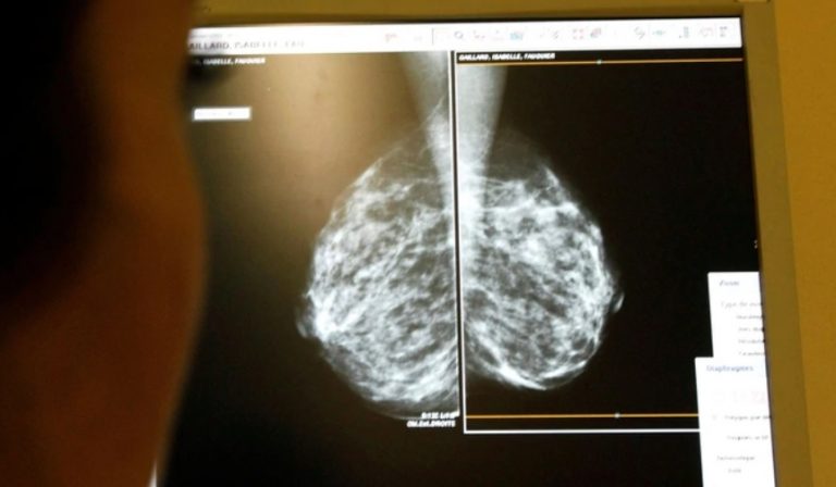 Desarrollaron un método para identificar el cáncer de mama con inteligencia artificial