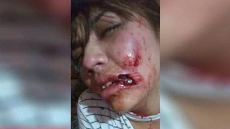 Neuquén: un joven atacó a su novia y le arrancó parte del labio