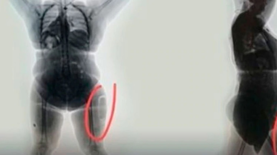 Una mujer intentó traficar cocaína implantada en sus muslos y la detuvieron en Colombia