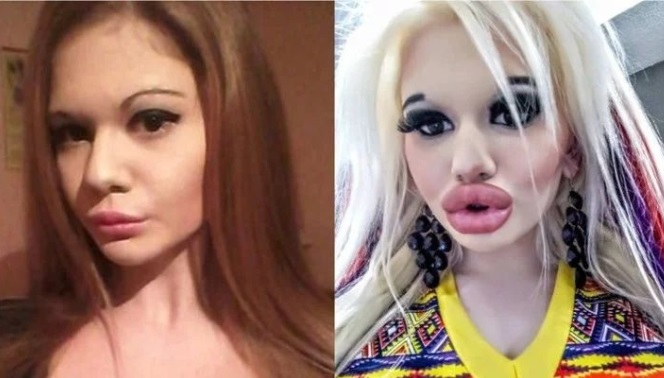 Se hizo 15 cirugías para triplicar el tamaño de sus labios