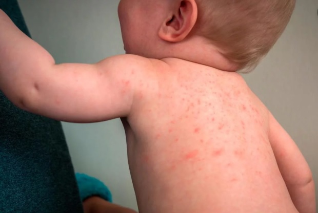 Confirman nuevos casos de sarampión en tres niñas no vacunadas y ya son 10 en el año