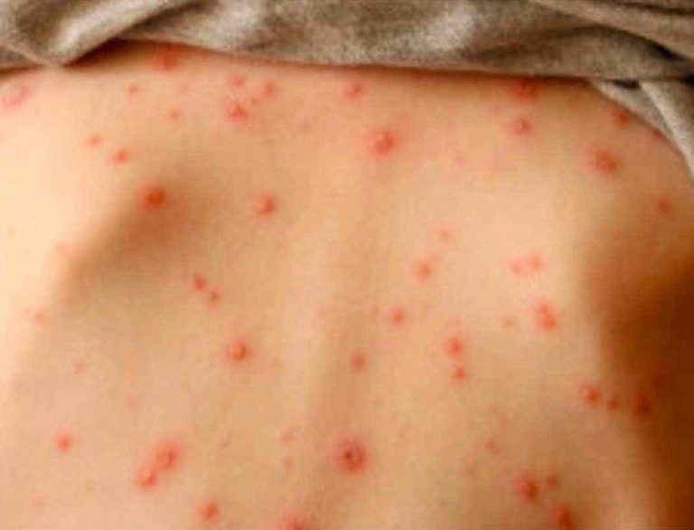 Alerta: confirman 18 casos de sarampión en el país
