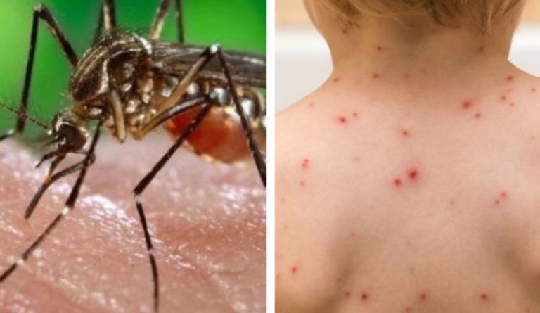 Boletín de Vigilancia de Salud: 113 casos de sarampión y 36 de dengue en el país