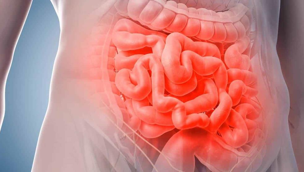 Qué síntomas pueden indicar cáncer de intestino