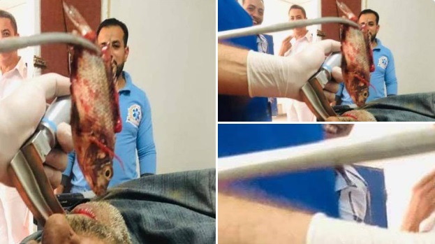 Imágenes sensibles: médicos extraen un pez vivo de la garganta de un hombre