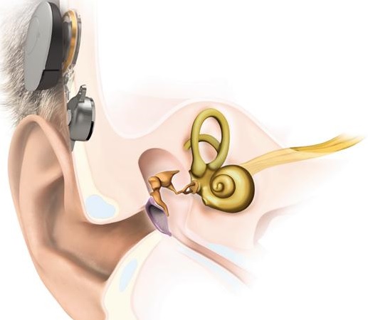 Misiones realizará el primer implante auditivo Bonebridge a un niño de 9 años