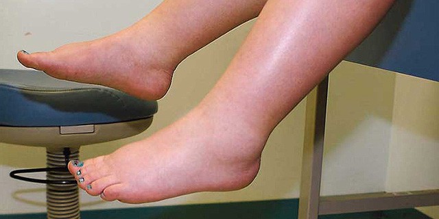 Linfedema: la enfermedad que se agravó con la pandemia