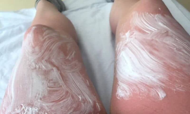 Fue a la cama solar y terminó internada con quemaduras graves