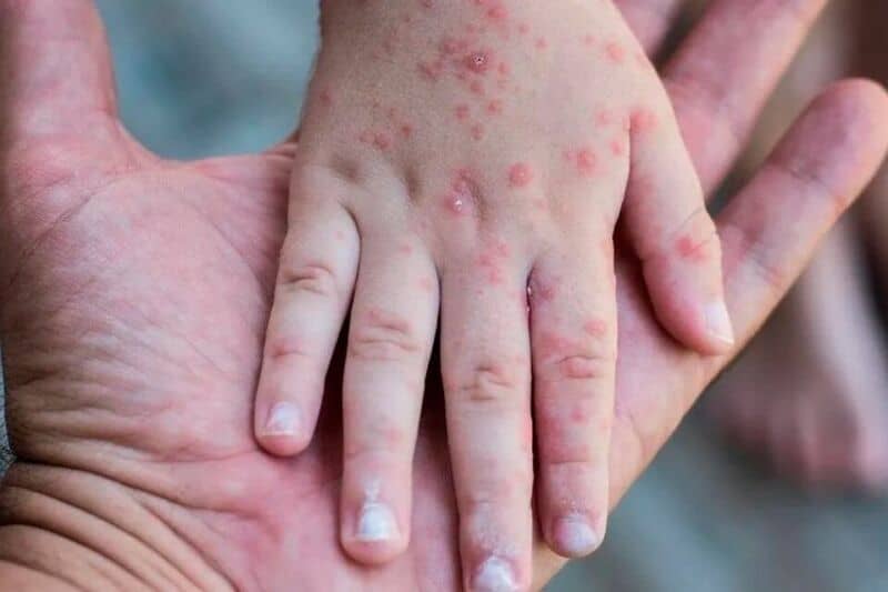 Paraguay declaró alerta epidemiológica tras detectar un brote de sarampión