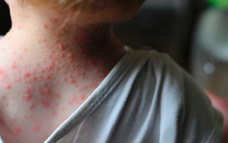 Viruela del mono: aseguran que puede ser detectada en fluidos biológicos como semen o saliva