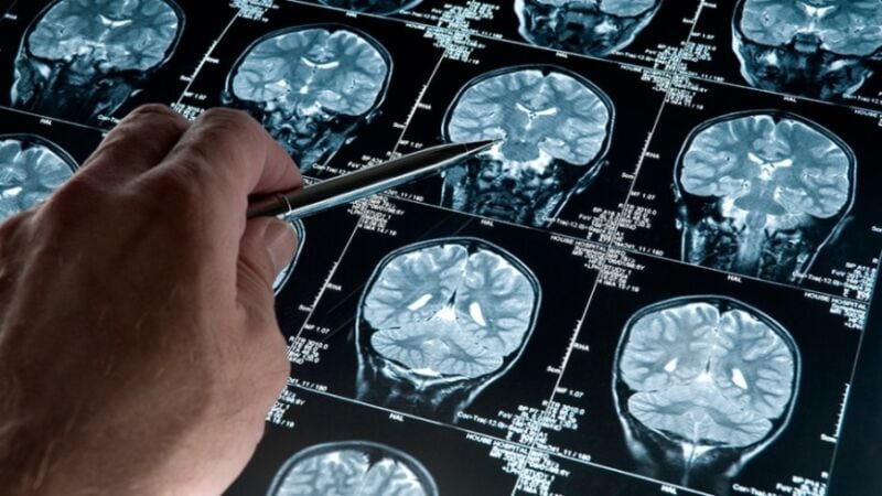 Crearon un sensor que puede identificar signos del Alzheimer hasta 17 años antes