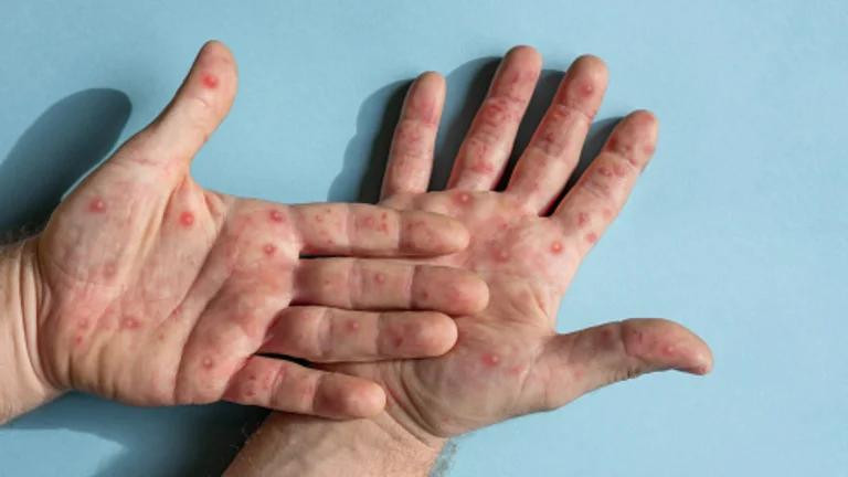 Córdoba: confirman cuatro casos de viruela del mono