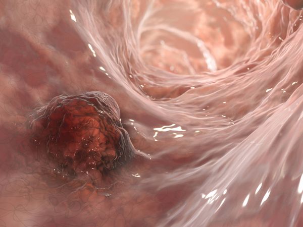 Un estudio identifica un nuevo gen que impulsa el cáncer de colon