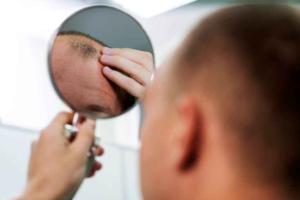 alopecia