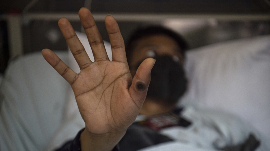 La OMS confirmó el cambio de nombre de la viruela del mono a mpox