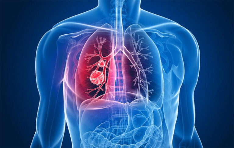 Cáncer de pulmón: destacan que un fármaco reduce el 34% de la tasa de progresión del tumor