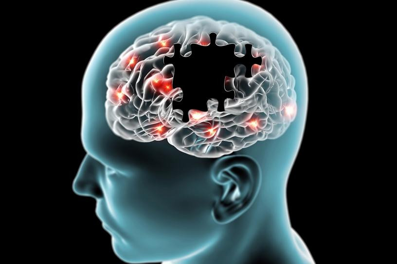 Alzhéimer: estudio arroja dudas sobre un prometedor medicamento experimental