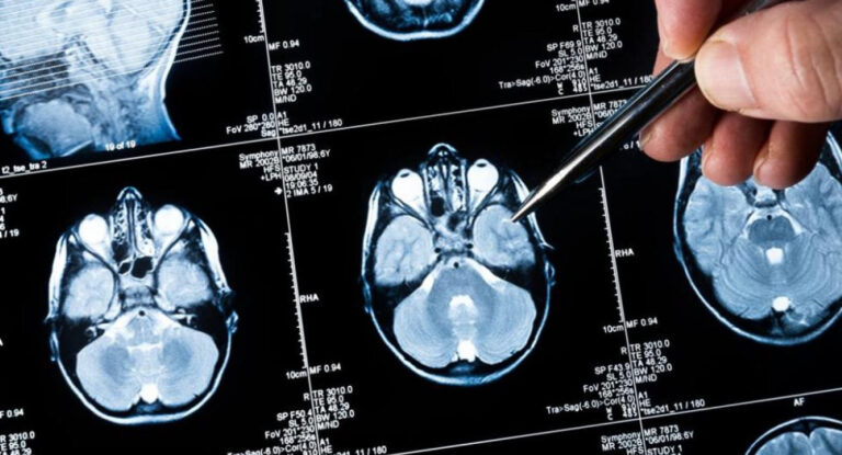 Logran analizar el ADN del cáncer cerebral durante una operación gracias a la inteligencia artificial