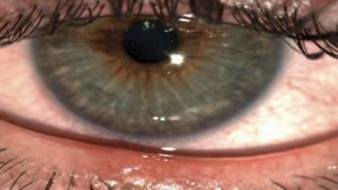 Alertan que tres de cada cuatro enfermos de rosácea pueden sufrir compromiso ocular