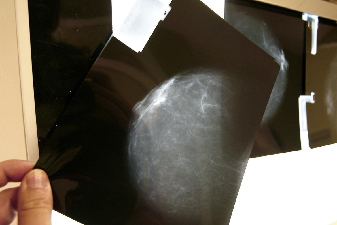 Estudio demuestra que la Inteligencia Artificial puede ayudar a la detección de cáncer de mama