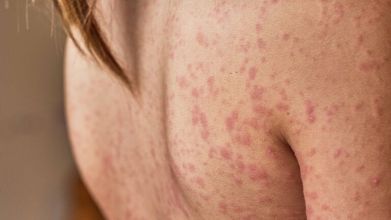 Misiones aprobó por ley un programa de abordaje de la dermatitis atópica