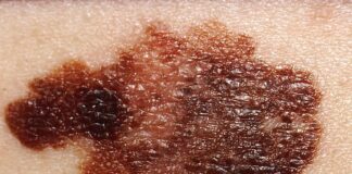 melanoma