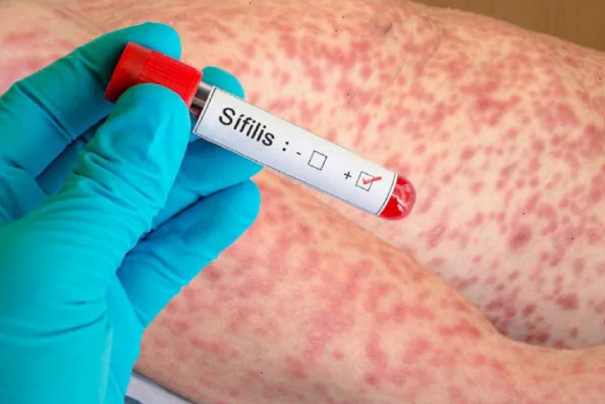 sifilis