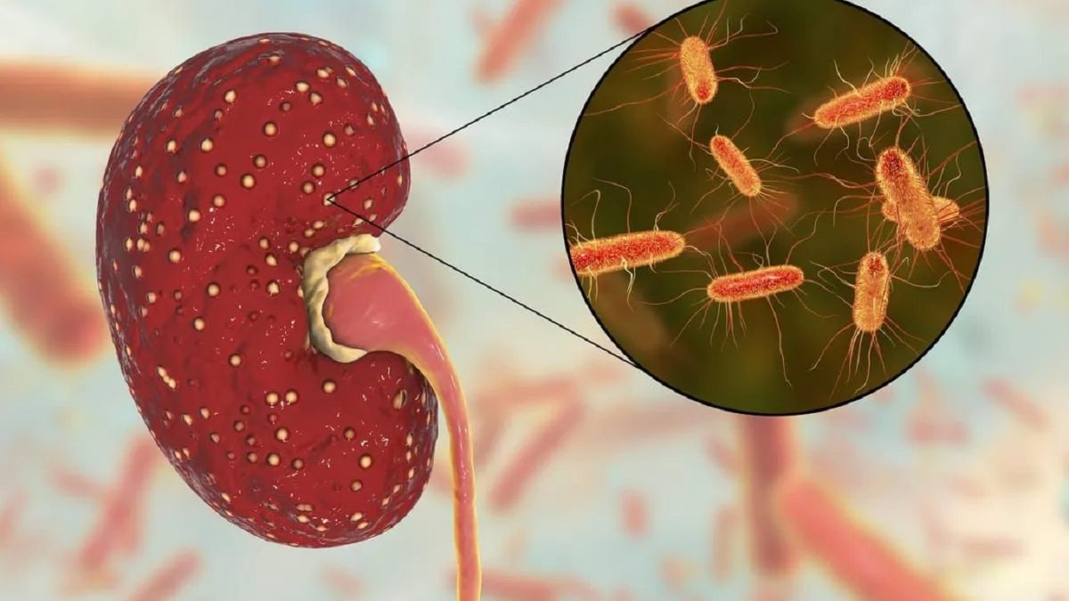 sindrome-uremico-hemolitico-finaljpg